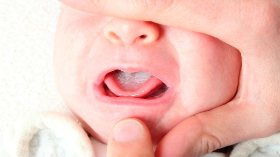 Молочница во рту у ребенка. Кандидоз