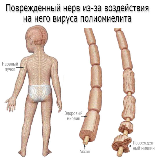 Полиомиелит: классификация, симптомы, диагностика и лечение