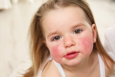 Аллергический диатез у детей — причины, симптомы